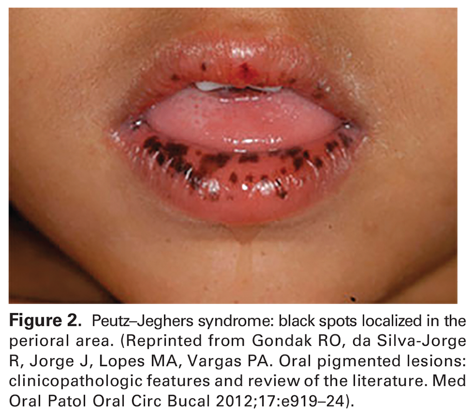 Figure 2. Peutz–Jeghers syndrome: black spots localized in the perioral area. (Reprinted from Gondak RO, da Silva-Jorge R, Jorge J, Lopes MA, Vargas PA. Oral pigmented lesions: clinicopathologic features and review of the literature. Med Oral Patol Oral Circ Bucal 2012;17:e919–24). 