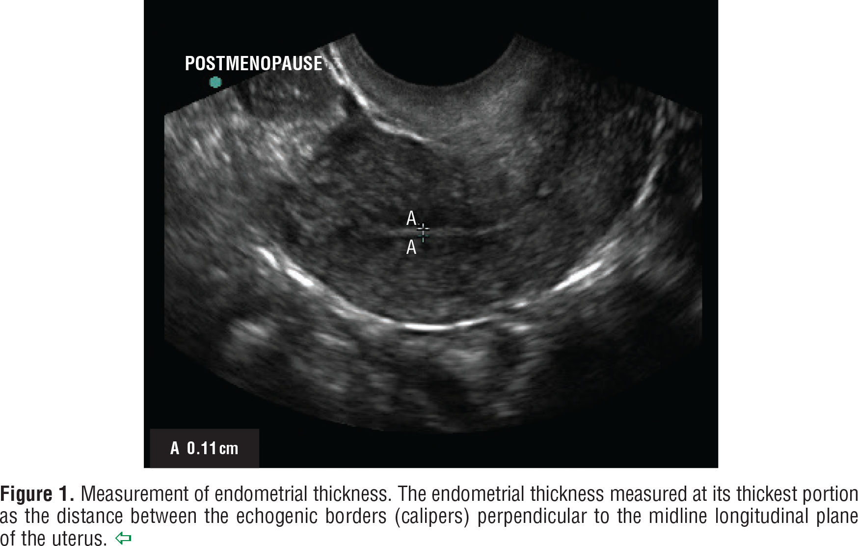 Figure 1. Measurement of endometrial thickness. The endometrial thickness measured at its thickest portion as the distance between the echogenic borders (calipers) perpendicular to the midline longitudinal plane of the uterus. 